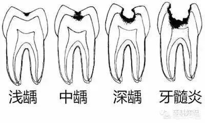 虫牙是真的有虫吗_虫牙是真的有虫吗?怎么治
